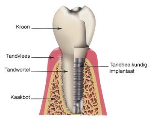 implantology-villa-westhof-dental