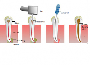 wortelkanaalbehandeling (endodontologie)